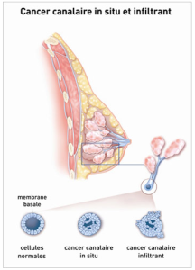 Cancer canalaire in situ et infiltrant