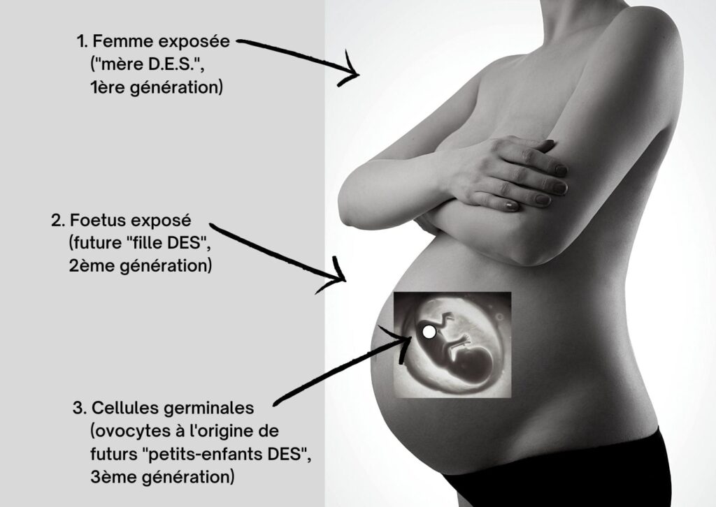 Illustration des 3 Générations exposées Distilbène (DES-France.org)