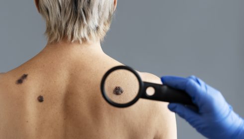 vidéo-cancer-de-la-peau-comment-prévenir_vignette